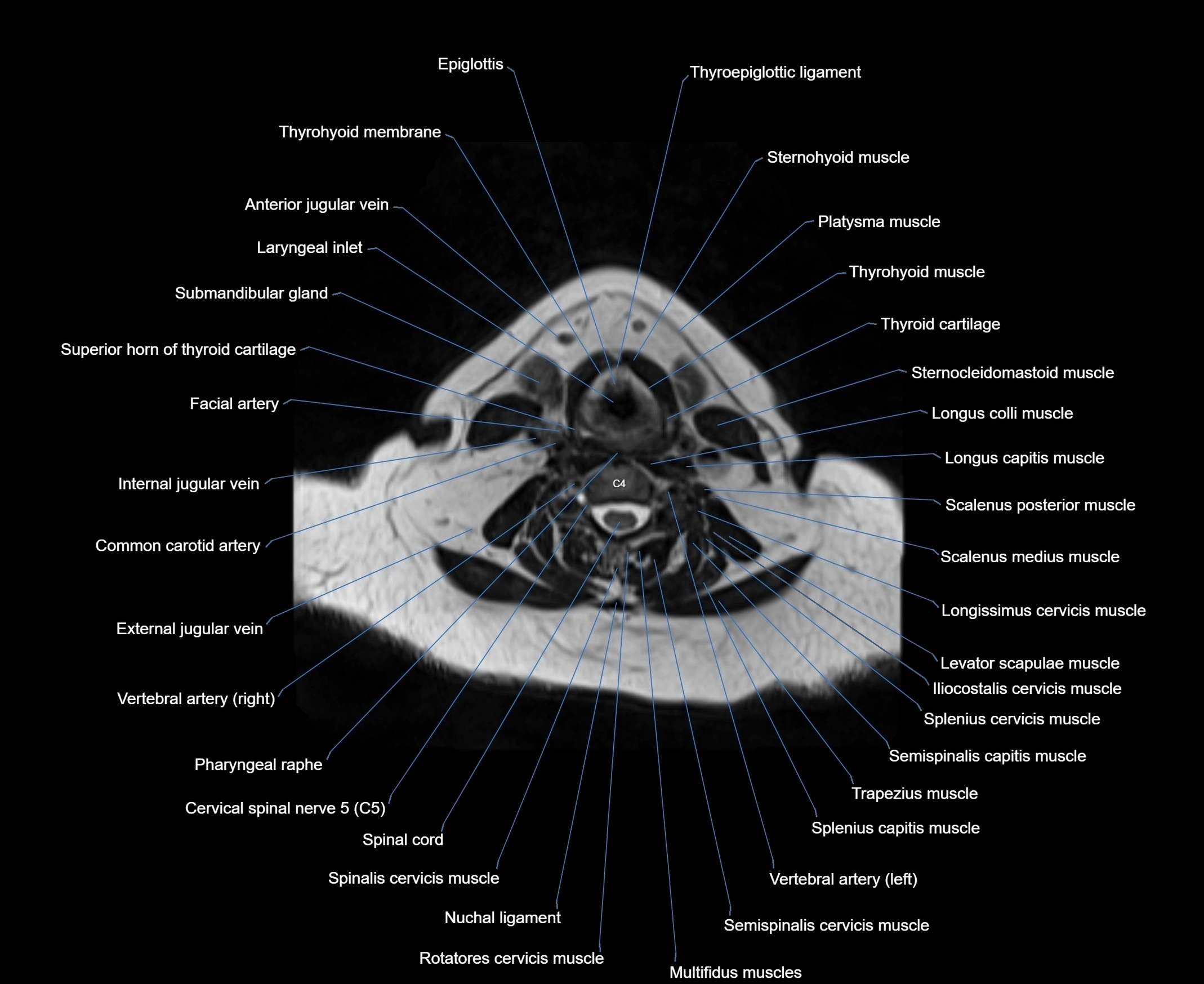 MRI Neck 3D labelled cross section anatomy axial 3t image-00001-00055.webp